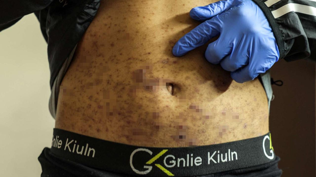 Terungkap Kondisi Miris Tahanan Palestina usai Dibebaskan Israel, Tubuh Kurus dan Penuh Kudis
