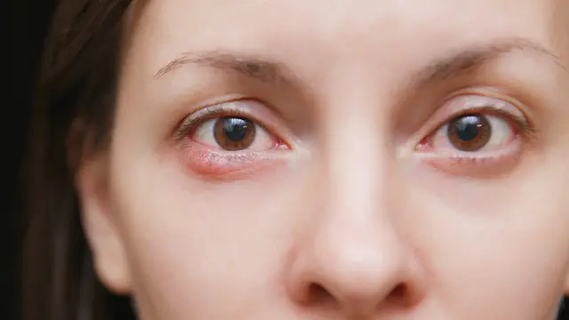 Menghilangkan Bintitan dengan 3 Cara Mudah Ini!