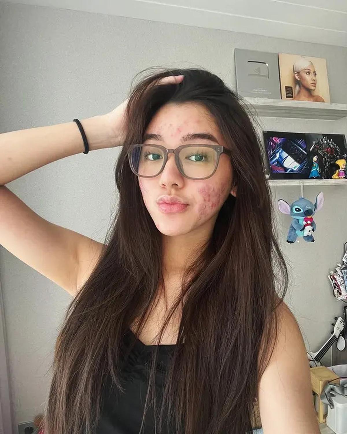 6 Potret Wajah Gabriella Ekaputri Berjerawat, Tetap Percaya Diri Tampil Natural