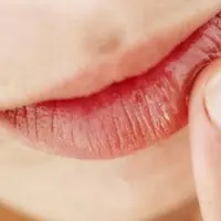 Supaya puasa kamu lancar tanpa alami bibir pecah-pecah, ikuti 5 cara berikut ya.