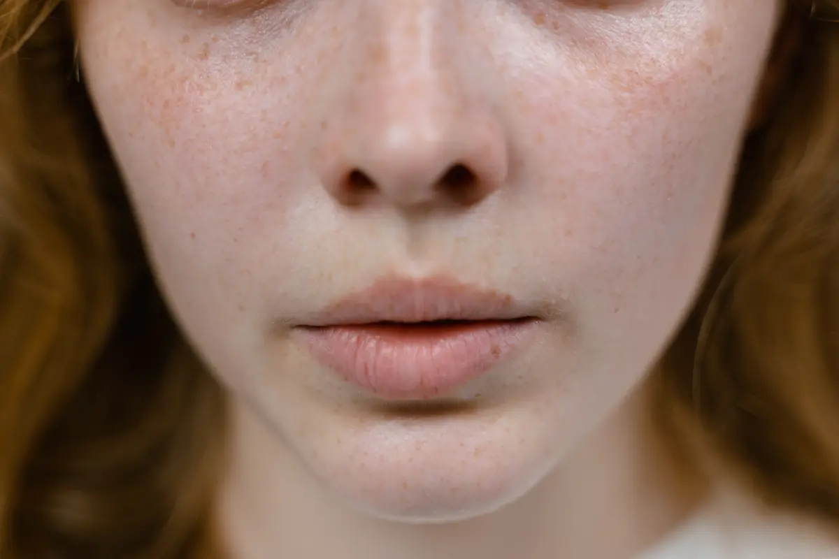 Ilustrasi Melasma