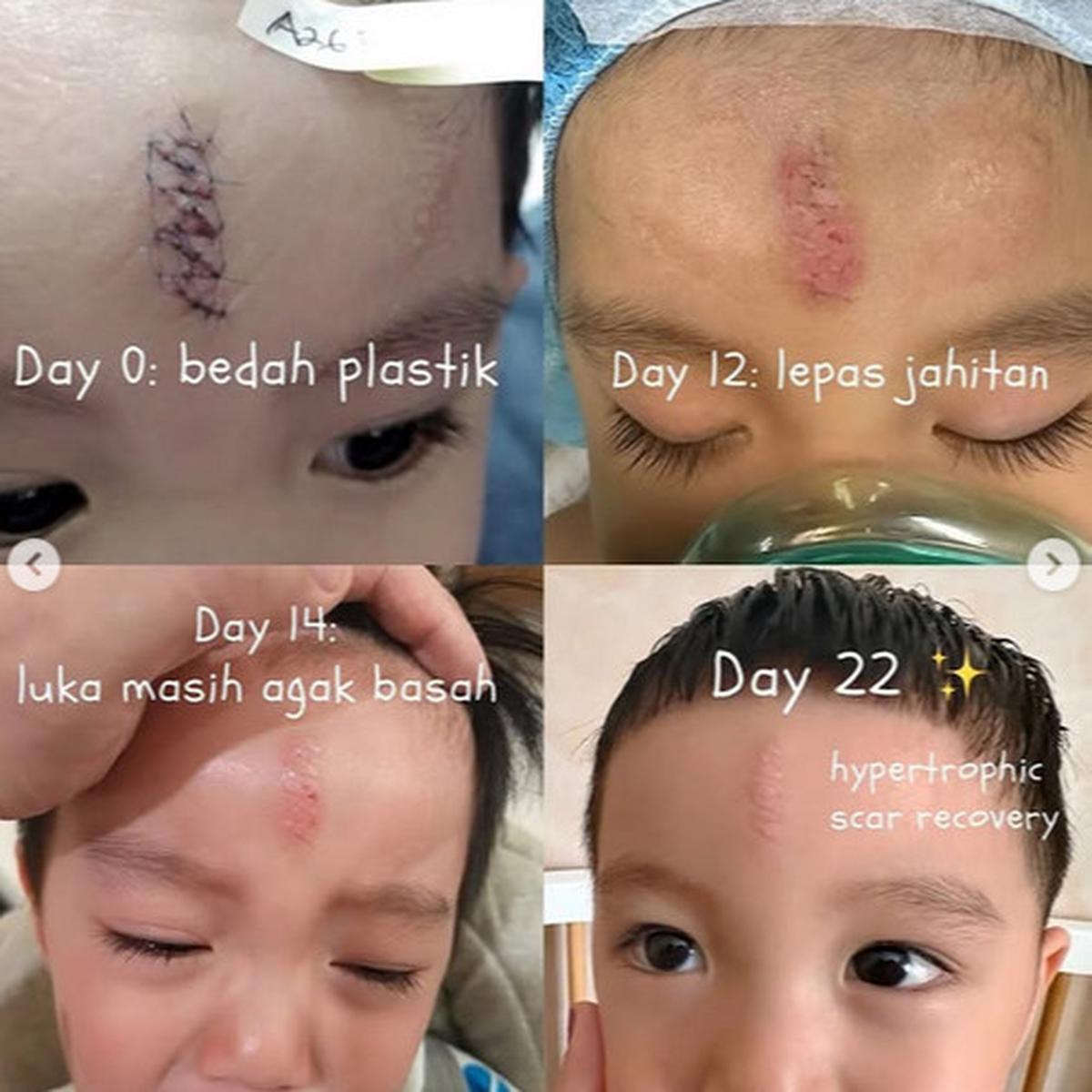 Jidat Kepentok Tembok, Anak Bungsu Chef Arnold Jalani Operasi di Usia 2 Tahun - Habiskan Biaya Rp70 Juta