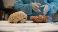 Para ilmuan dan dokter telah menemukan cara yang lebih efisien untuk mengoperasi otak. | via: nytimes.com