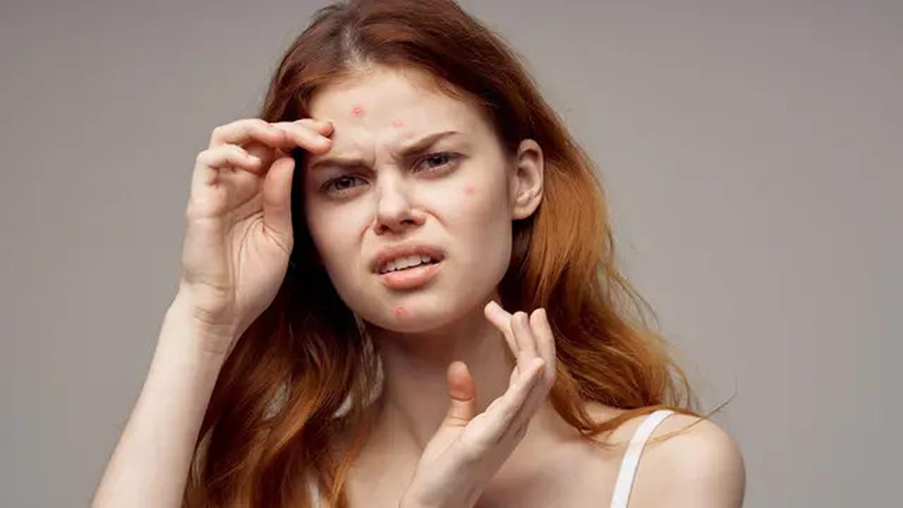 Cegah Jerawat Pecah Berbekas, Yuk Lakukan Rutinitas Perawatan yang Tepat!