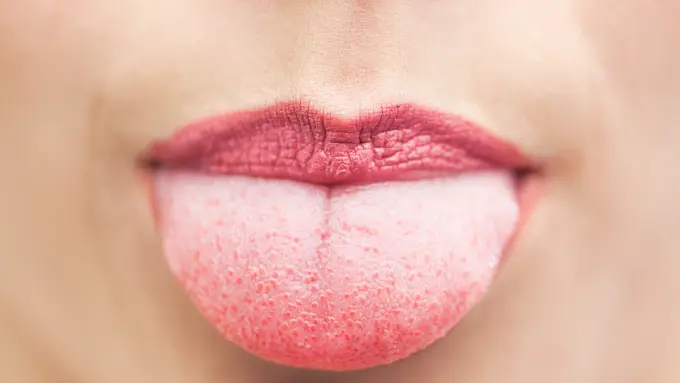 Ini 5 Gejala Kanker Lidah