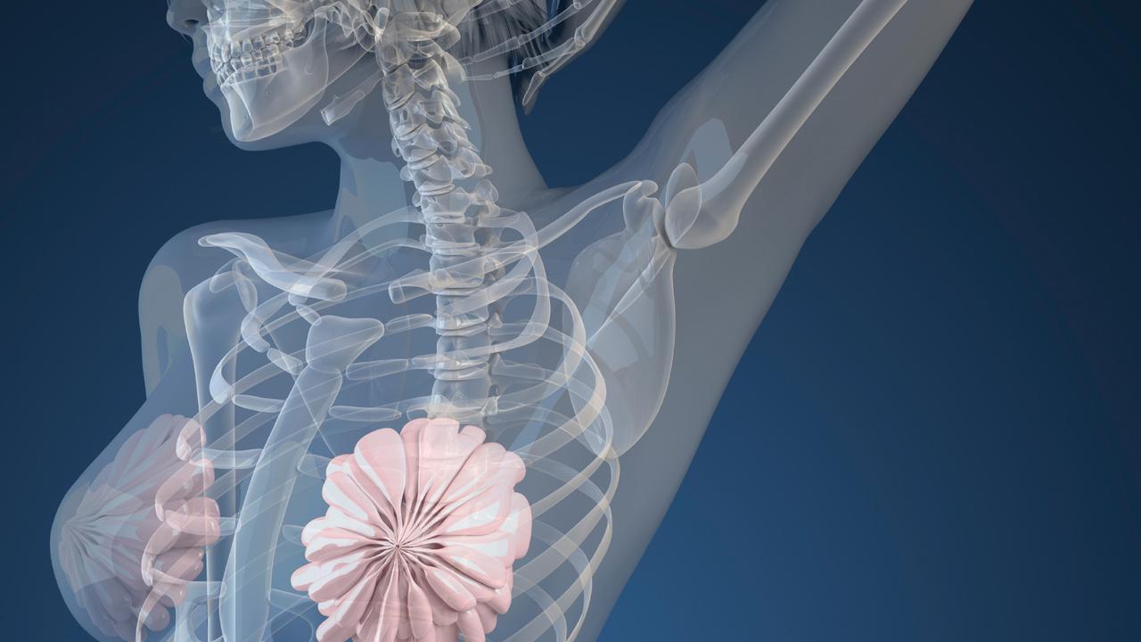 Ilustrasi Kanker Payudara