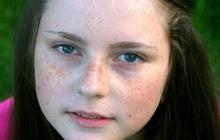 Waspadai Freckles di Wajah: Simbol Kecantikan atau Sinyal Masalah Kesehatan? Ini Penjelasan Medisnya