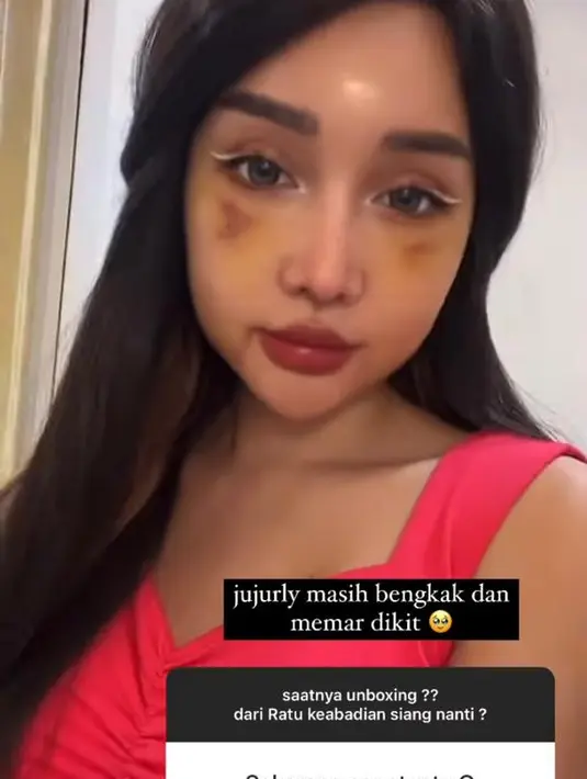 Meski masih memar dan bengkak, perubahan wajah pelantun “Jom-jom Manjalita” ini terlihat lebih cantik dari sebelumnya. (Instagram/lucintaluna_manjalita)