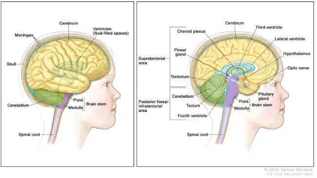 Ilustrasi keadaan otak anak penderita kanker batang otak (diffuse intrinsic pontine glioma, DIPG). (Sumber National Cancer Institute/Terese Winslow)