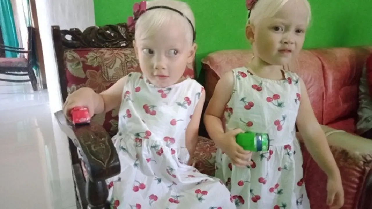 Anak Albino
