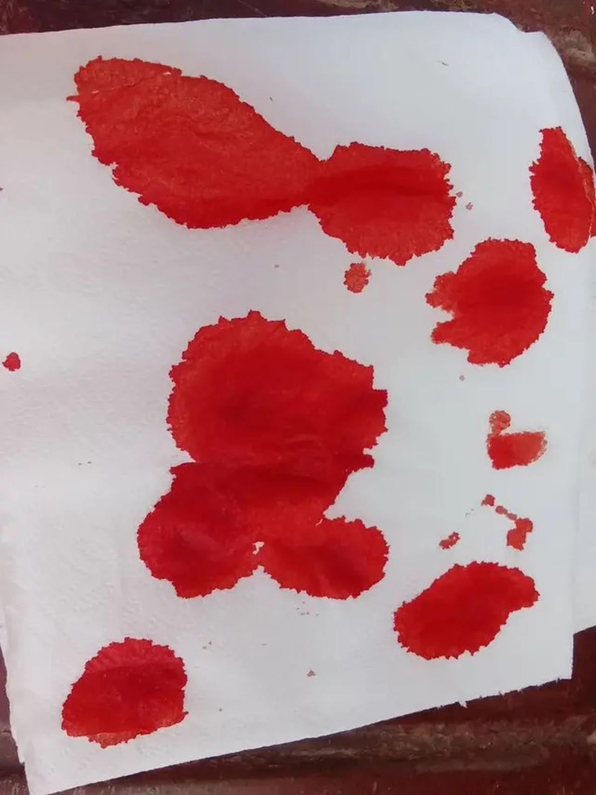 Cara Tepat Merawat Anak dengan Hemofilia agar Tetap Sehat dan Aktif