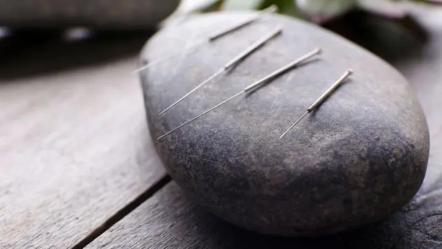 Mengatasi Sakit Kepala dengan Akupunktur