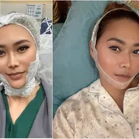 Potret Inul Daratista perawatan wajah tirus tanpa oplas. (sumber: Instagram/inul.d)