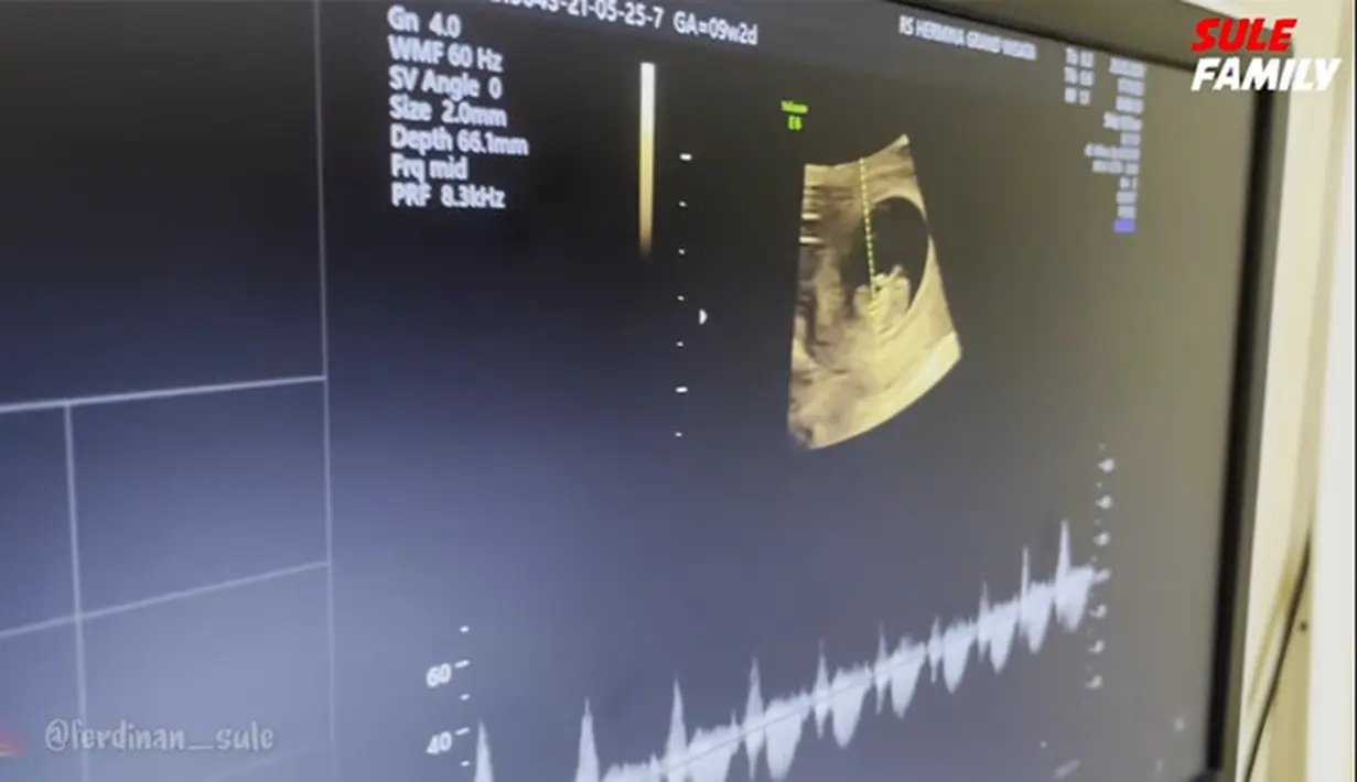 Sule Antar Nathalie Holscher Periksa Kehamilan (Youtube/ SULE FAMILY)