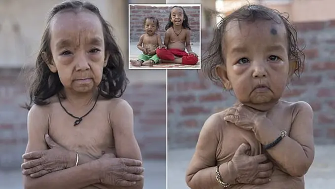 Dua Bocah Ini Alami Penuaan Dini, Titisan Benjamin Button?