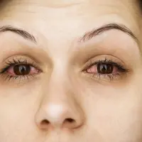 Bahaya sedang mengancam kamu para wanita yang suka pakai bulu mata palsu.