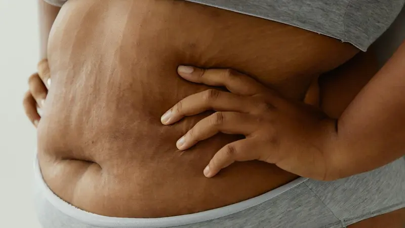 Wanita berbadan gemuk memiliki stretch mark di perutnya