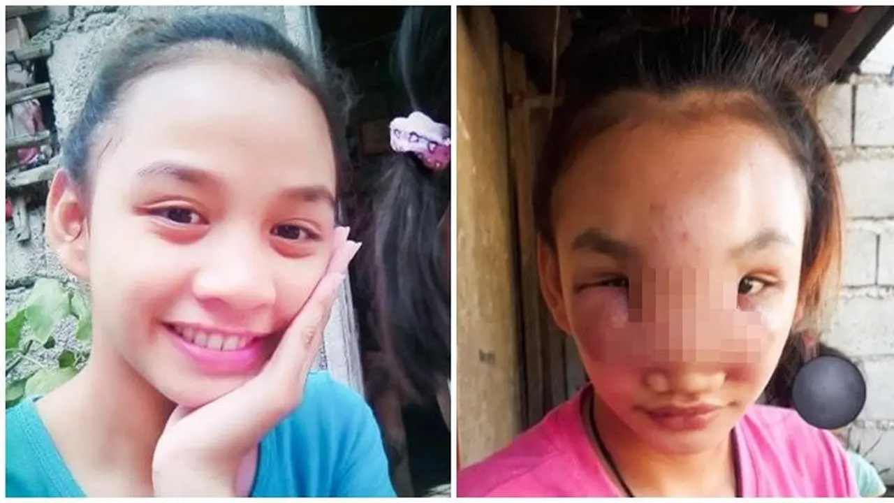 Viral, Wanita Ini Hampir Alami Kebutaan Usai Pencet Jerawat