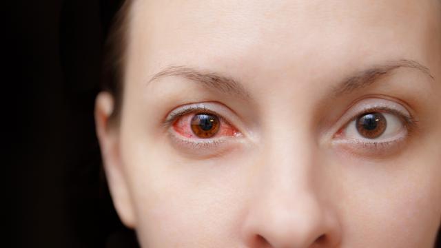 6 Penyebab  Mata  Merah yang Harus Diwaspadai Jangan Anggap 