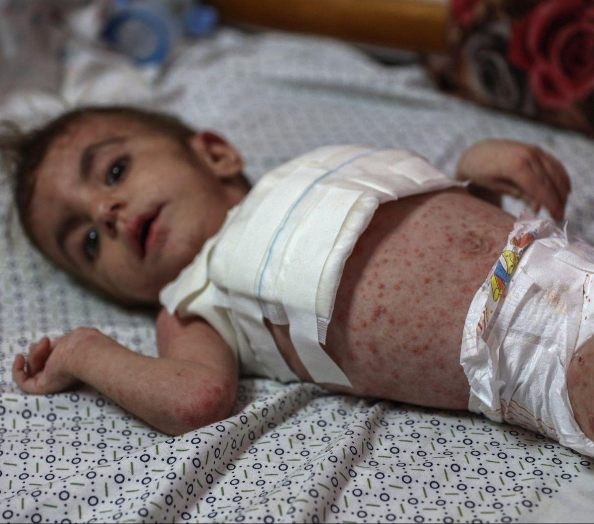 Bayi perempuan Wateen al-Adasi mendapatkan perawatan di sebuah rumah sakit di Beit Lahia, Jalur Gaza, Palestina, pada 2 Juli 2024.&nbsp;Wateen al-Adasi, yang dirawat karena gizi buruk, juga menderita penyakit kulit. Bintik-bintik merah tersebar hampir di 