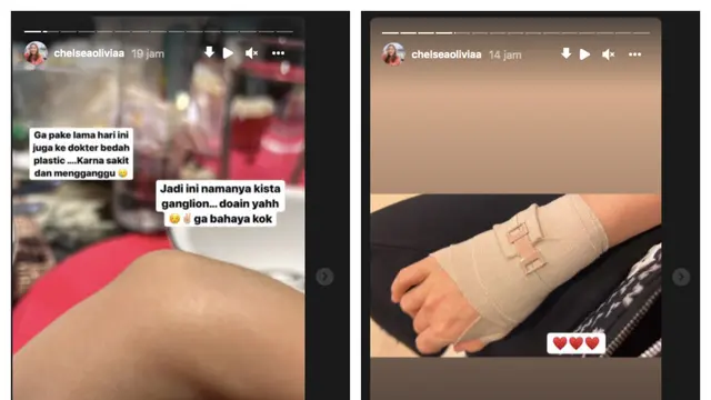 Chelsea Olivia Jalani Operasi untuk Benjolan yang Muncul di Tangannya. (instagram.com/chelseaoliviaa)