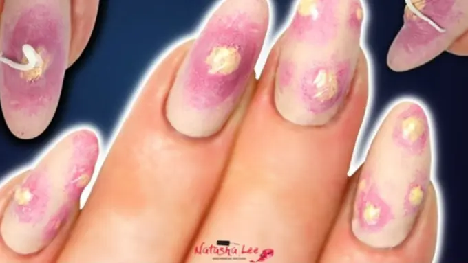 Tren Terbaru, Nail Art Unik Bentuk Jerawat!