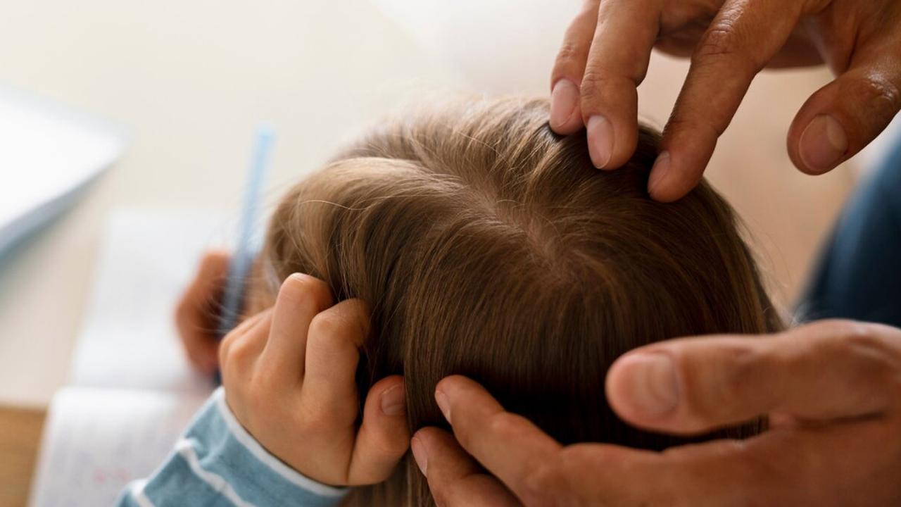 Cara Penularan Kutu Rambut Bikin Kepala Gatal Bukan Main, Ikuti Trik Mencegah dan Mengatasinya