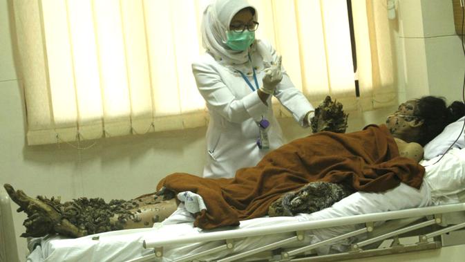 Si Manusia Akar Akan Kembali Jalani Operasi Health Liputan6 Com