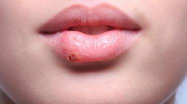 mengenal penyakit herpes genital dan