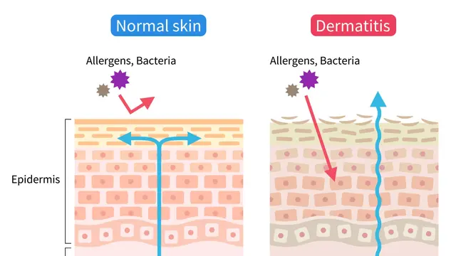 Ilustrasi skin barrier (Foto: Gemini AI)