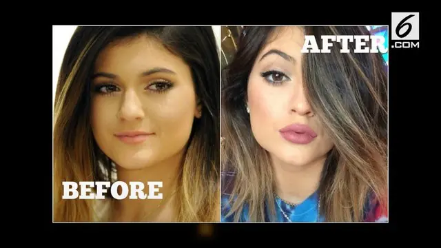 VIDEO: Kylie Jenner Lakukan 6 Operasi Plastik Ini