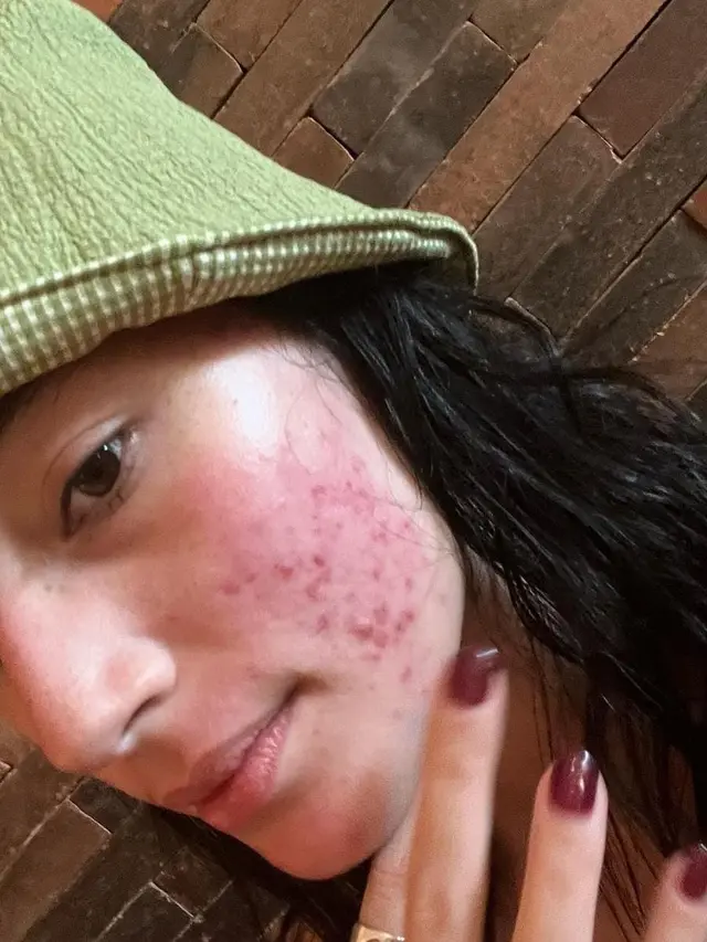 Tatjana Sapira mengunggah foto wajah penuh jerawat