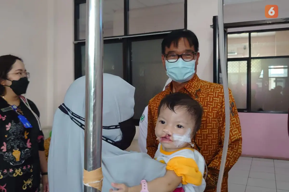 Operasi Bibir Sumbing