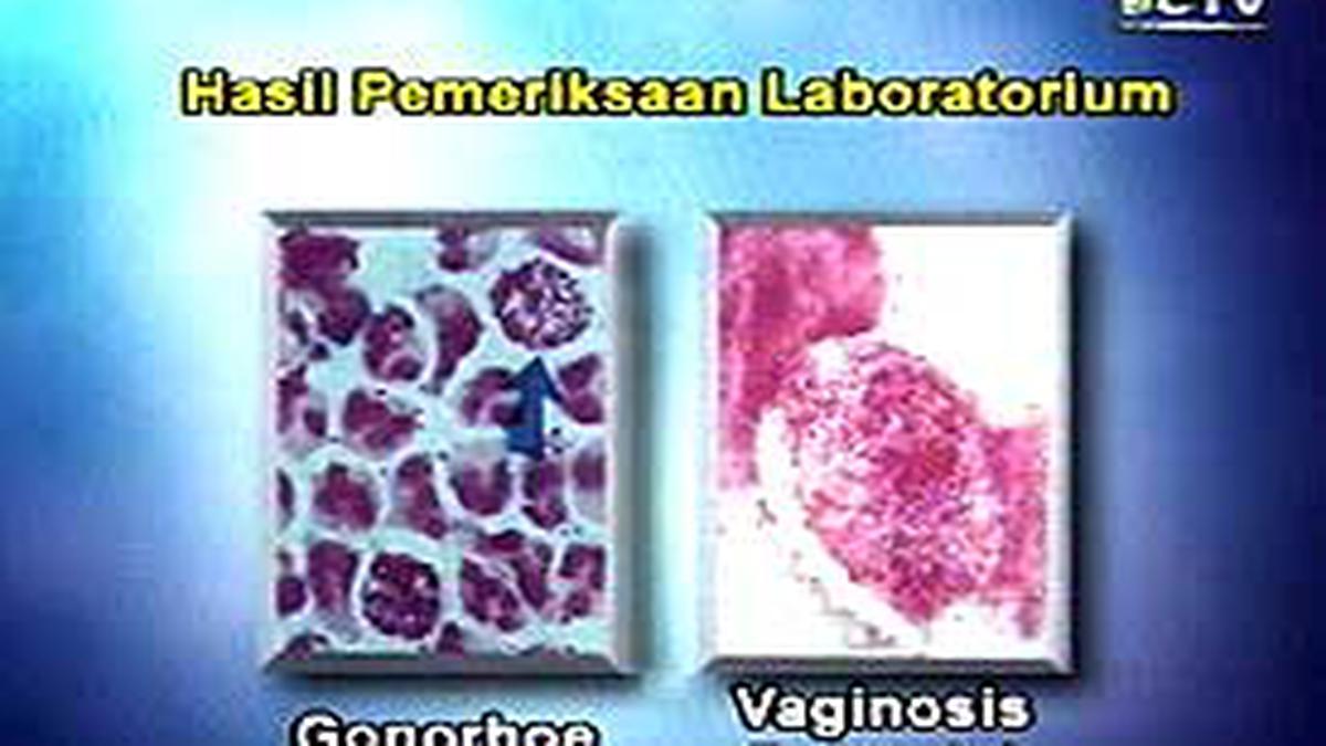 Keputihan Jangan Dianggap Enteng - News Liputan6.com