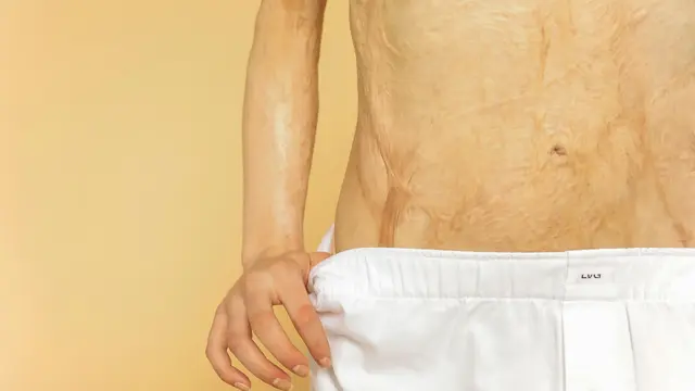 Mengapa Bekas Luka Bakar Perlu Dirawat?