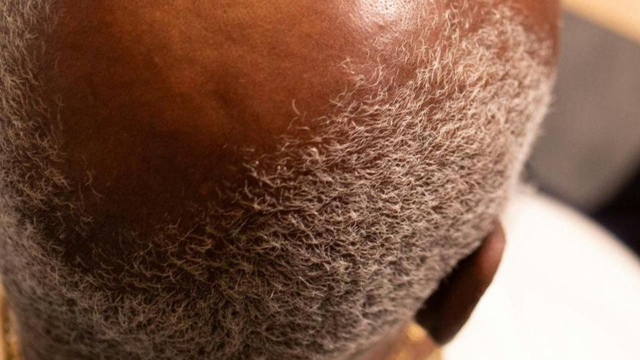 10 Bahan Alami untuk Menumbuhkan Rambut Botak, Bisa Dicoba