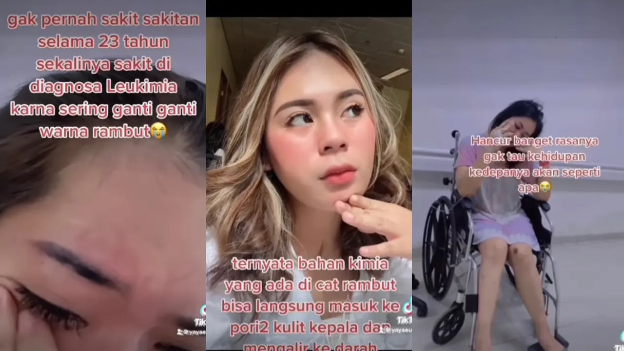 Potret Nanda, Wanita 23 Tahun yang Didiagnosa Leukimia Akibat Cat Rambut (Sumber: Instagram @nandasoraya11)