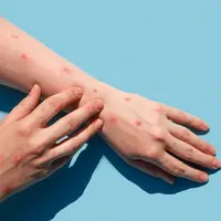 Tips Menjaga Kesehatan Kulit Bila Terserang Monkeypox/copyright shutterstock/Marina Demidiuk