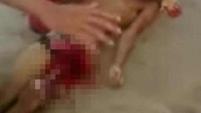 Remaja Tewas Setalah Kehilangan Penis Akibat Gigitan Hiu