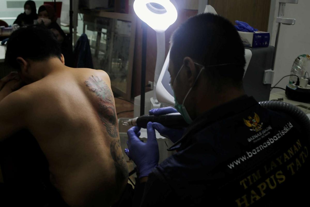 Layanan Hapus Tato Gratis di Jakarta