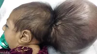 Asree Gul, Bayi Perempuan 3 Bulan Punya 2 Kepala