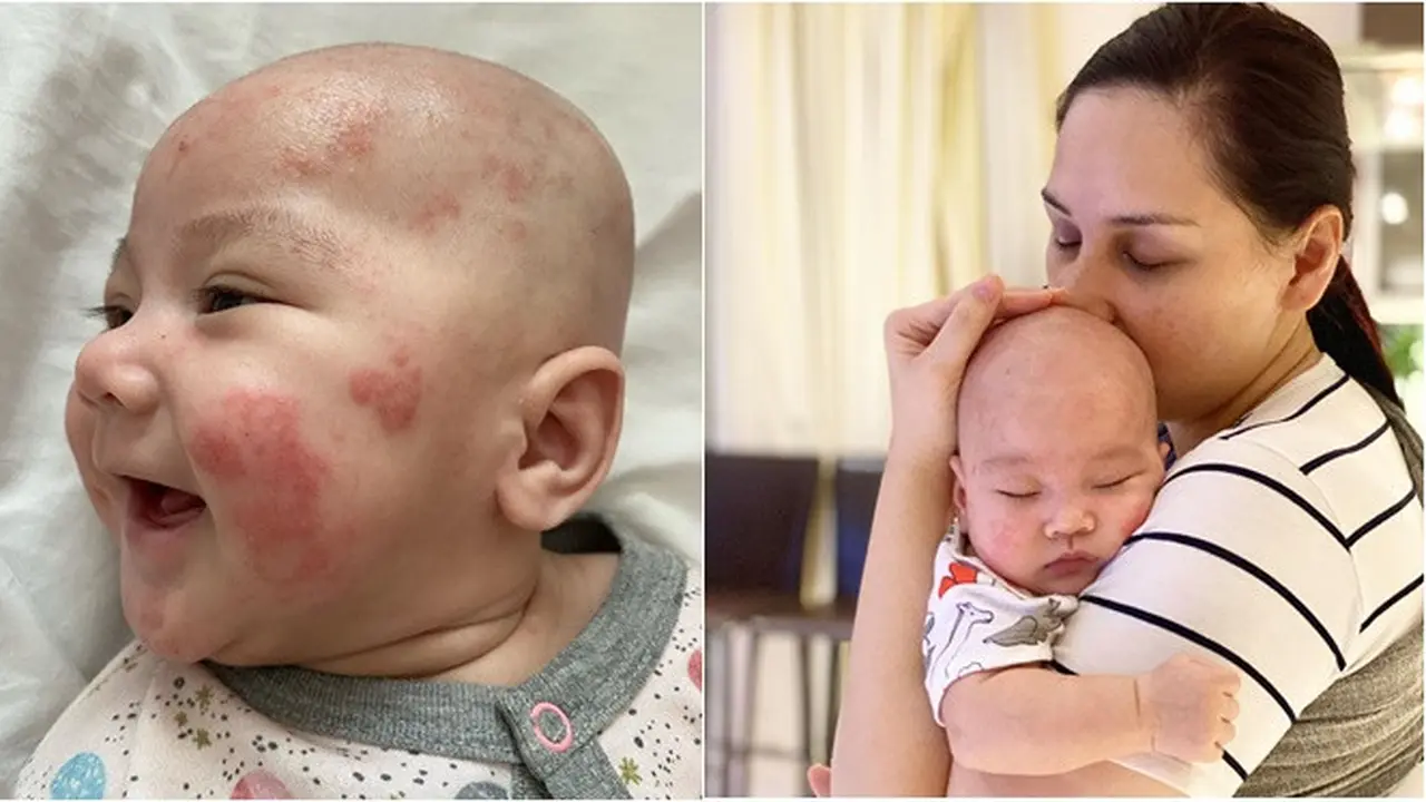 7 Potret Perjuangan Mona Ratuliu Rawat Anak yang Idap Dermatitis Atopik