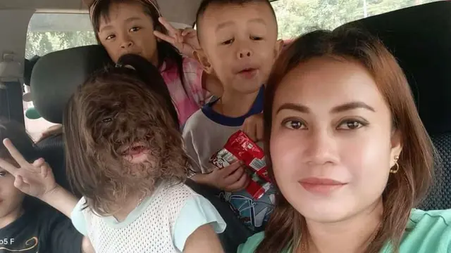 Missclyen seorang balita usia 2 tahun sindrom manusia serigala bersama adik dan ibunya