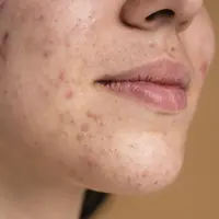 ilustrasi jerawat akibat rusaknya skin barrier/copyright&nbsp;freepik.com/freepik