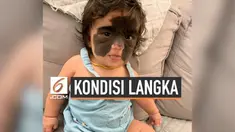 Pasangan asal Brasil mempunyai seorang anak bernama Luna. Sejak lahir, Luna memiliki tanda lahir yang hampir memenuhi seluruh wajahnya karena perubahan genetik ketika berada di dalam rahim sang ibu.