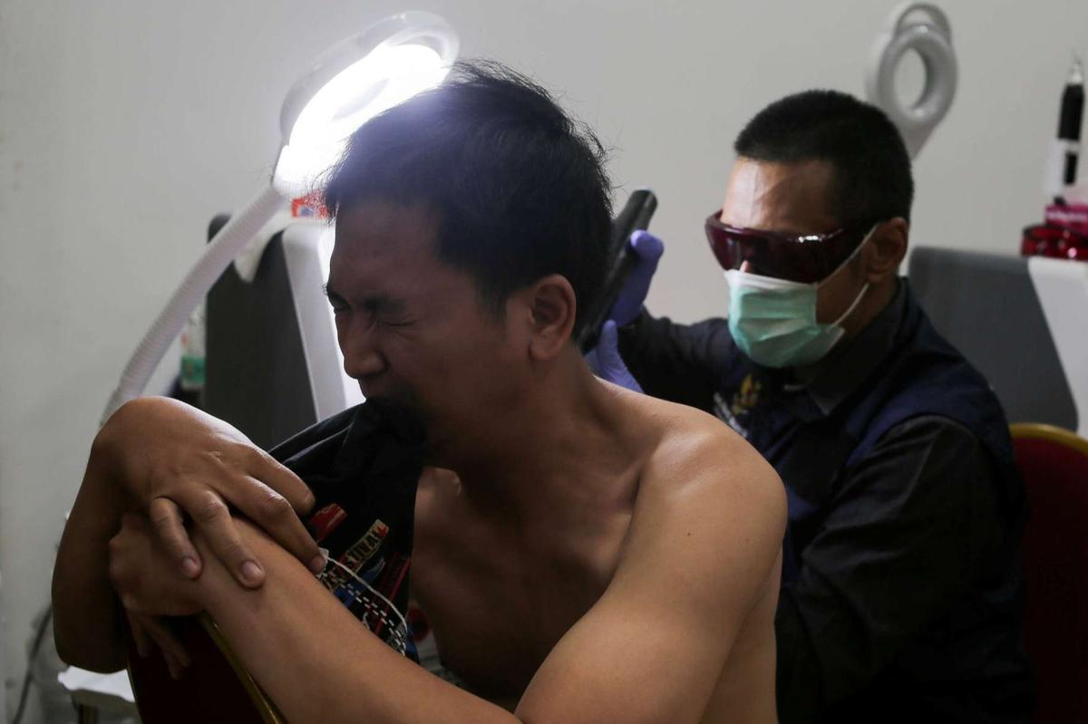 Layanan Hapus Tato Gratis di Jakarta