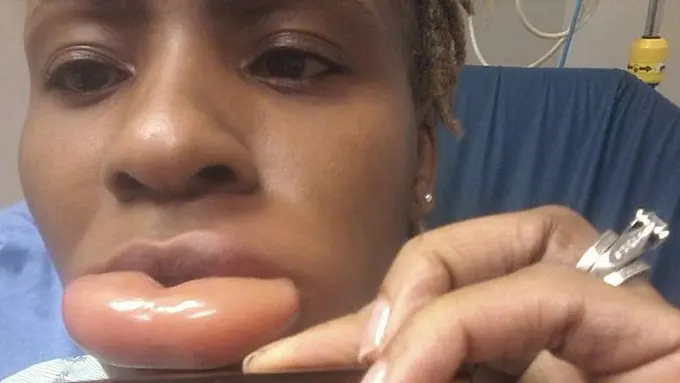 Ngeri! Salah Pakai Lipstik, Bibir Perempuan Ini Jontor Parah!