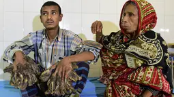 Abul Bajandar (26) mengalami kutil berlebihan yang membuatnya tampak seperti manusia akar, di Dhaka Medical College dan Rumah Sakit, Bangladesh, Minggu (31/1). Kini jaringan-jaringan akar itu tumbuh di kedua tangan dan kakinya.  (AFP Photo/Munir uz ZAMAN)