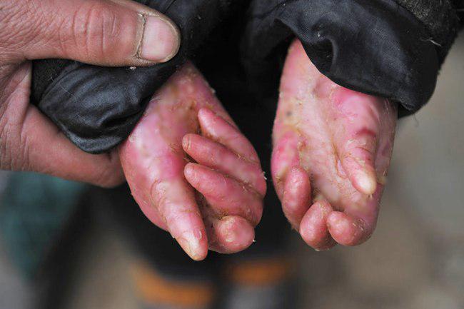 Luka-luka menyebabkan jari-jari Liuchen menyatu | foto: copyright chinadaily.com.cn