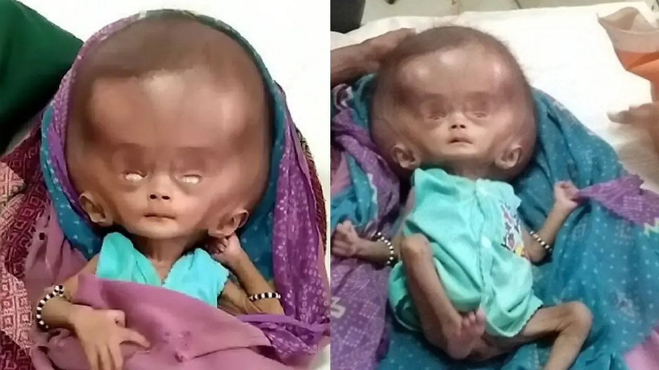 Butuh Bantuan, Bayi Malang Alami Hidrosefalus Sebesar 71 Cm